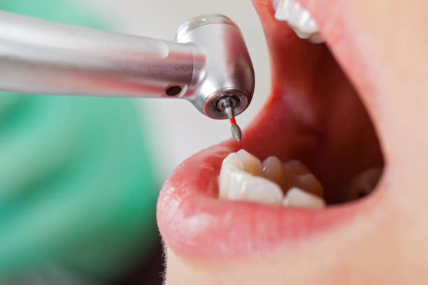 Best Emergency Wisdom Teeth Removal in Pinehurst, NC
